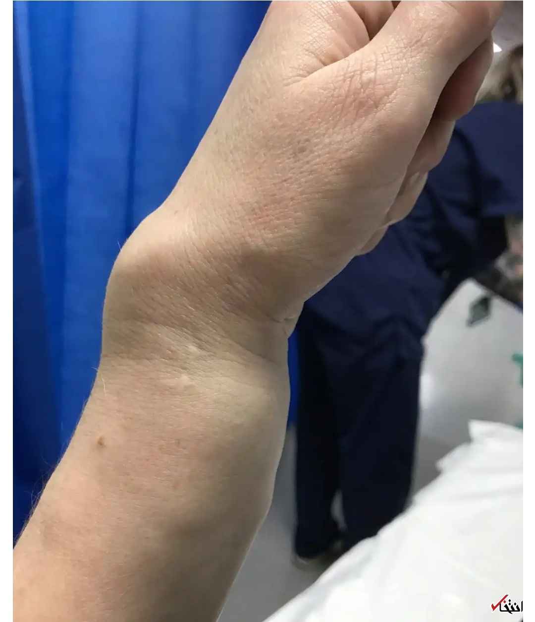 واکسن آسترازنکا