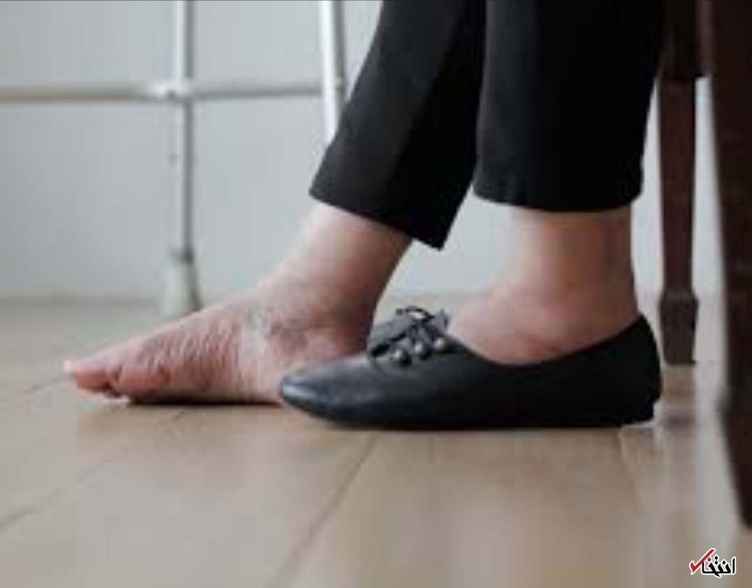 ورم پا یک عارضه ساده نیست/ از نارسایی قلبی تا اختلال در سیستم لنفاوی