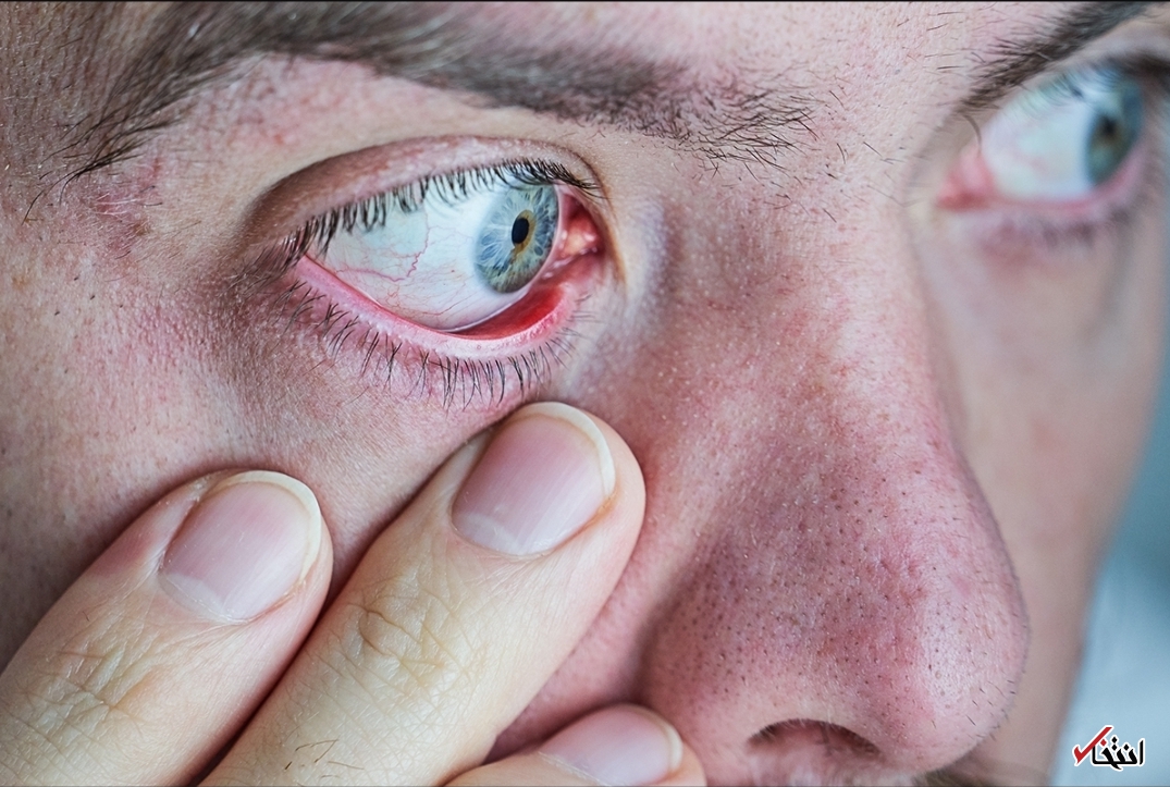 خطر &laquo;سندرم خشکی چشم&raquo; برای کاربران تلفن همراه