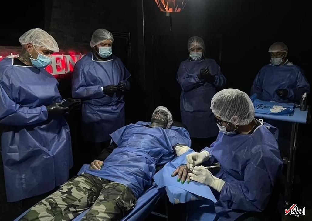 عجیب&zwnj;ترین جراحی زیبایی جهان/قطع انگشتان دست برای ایجاد پنجه! +تصاویر